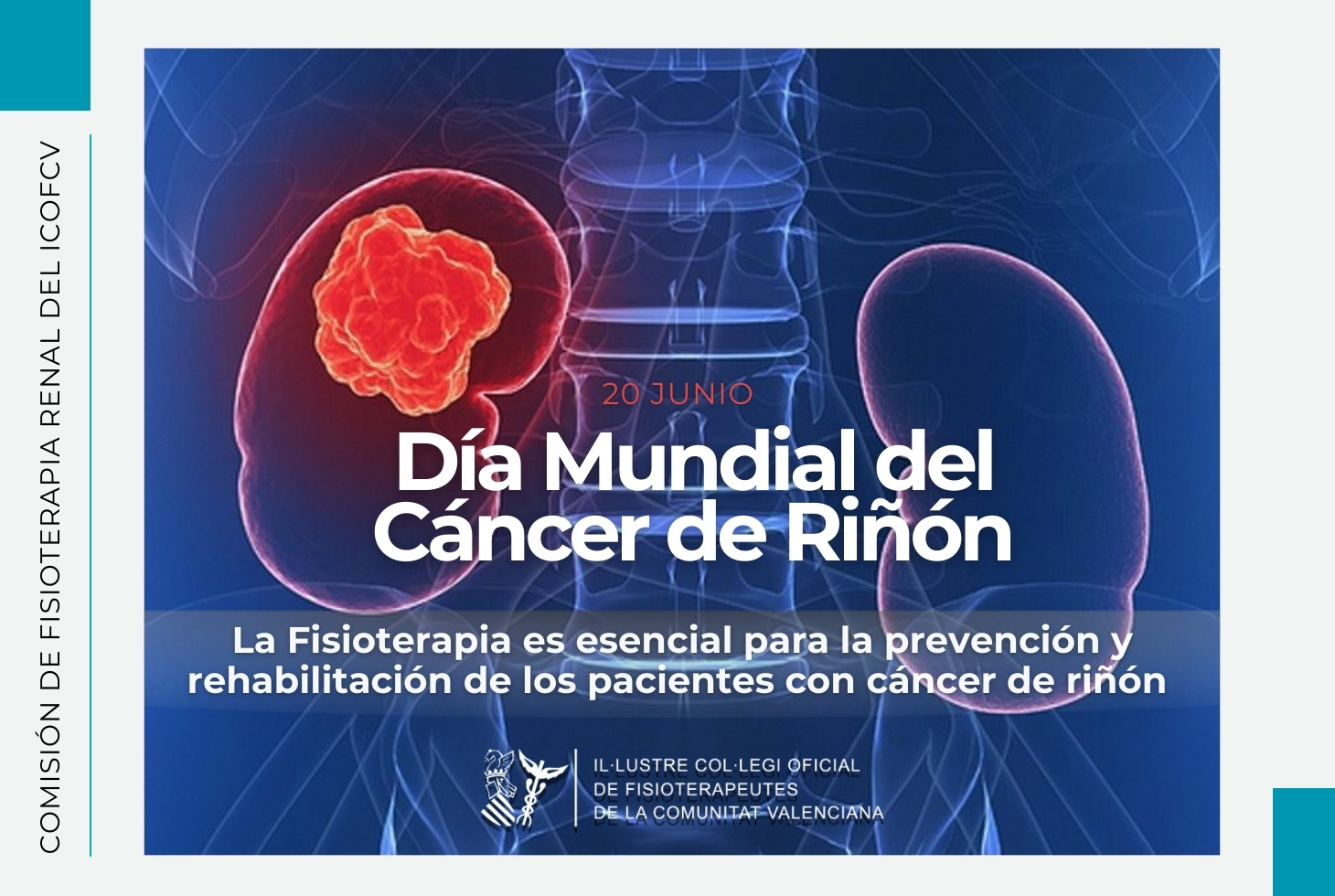 Día Mundial del Cáncer de Riñón: el ejercicio físico con fines terapéuticos es vital en la lucha contra la enfermedad